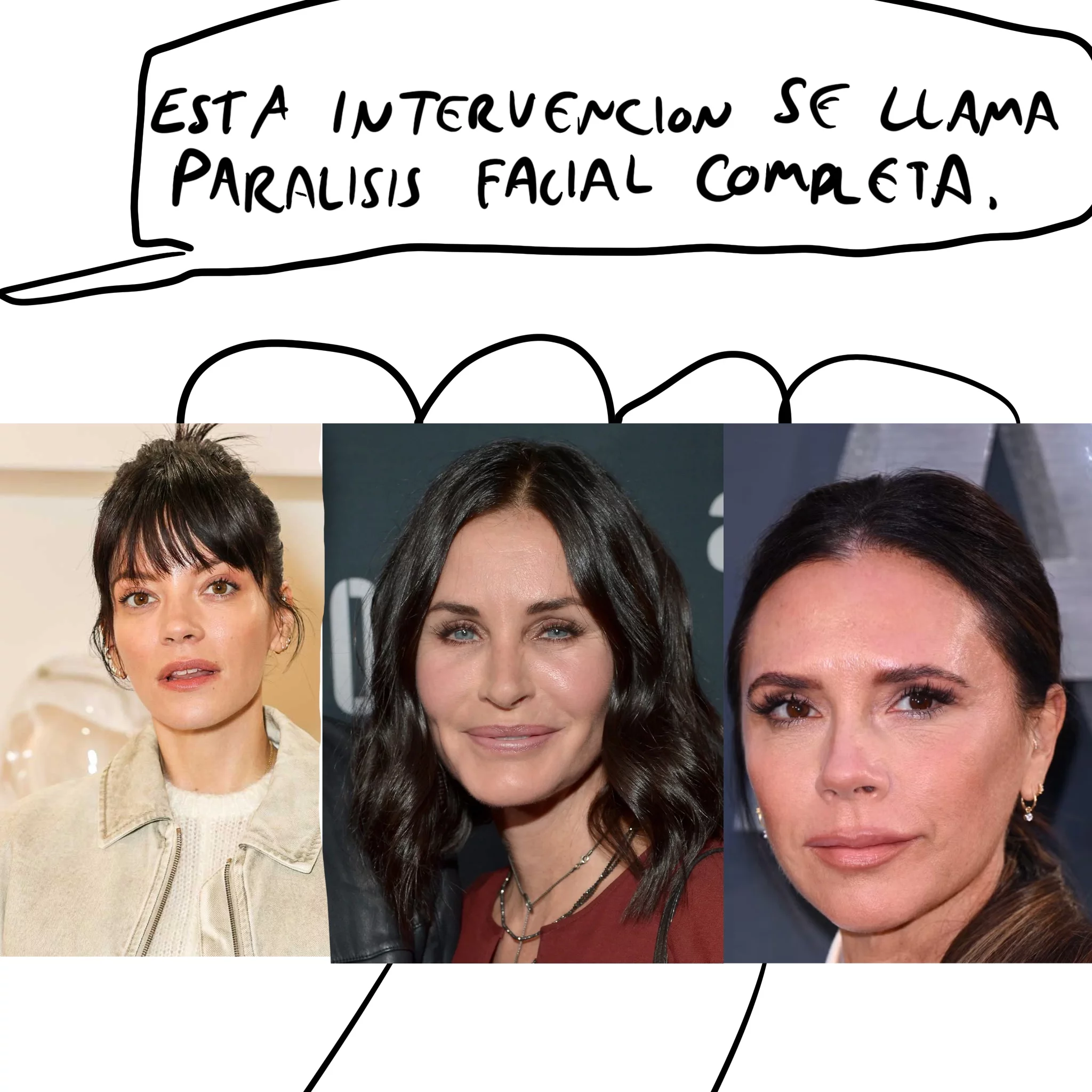 paralisis facial